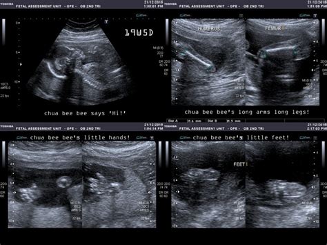 Anomaly scan 20 weeks .